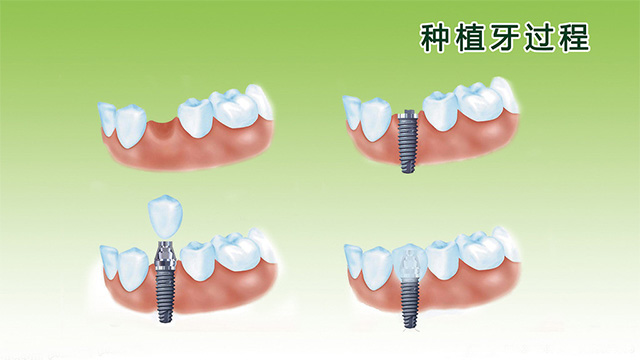 种植牙过程