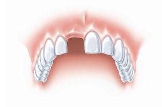 单颗牙缺失