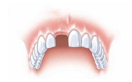 单颗牙缺失