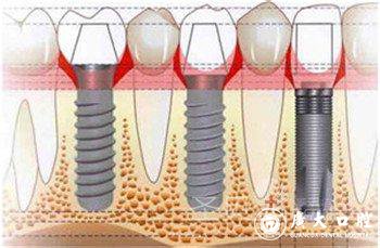 深圳种植牙